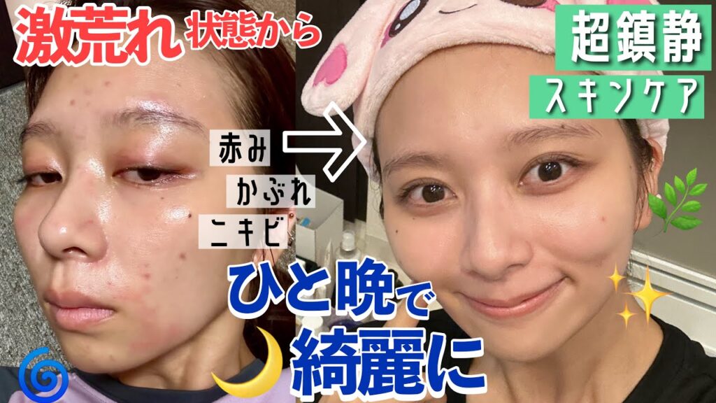 【効果絶大💊】ほぼプチプラ！肌が荒れてる時に一晩でどうにかする最強鎮静スキンケア！痛くないシミないスキンケア！！【肌に一番優しいスキンケア】