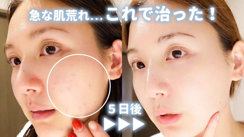 【肌荒れvlog】急なニキビ...？も5日間でここまで回復！美白も叶う私のレスキューアイテム紹介🧖‍♀️🌙【スキンケア】